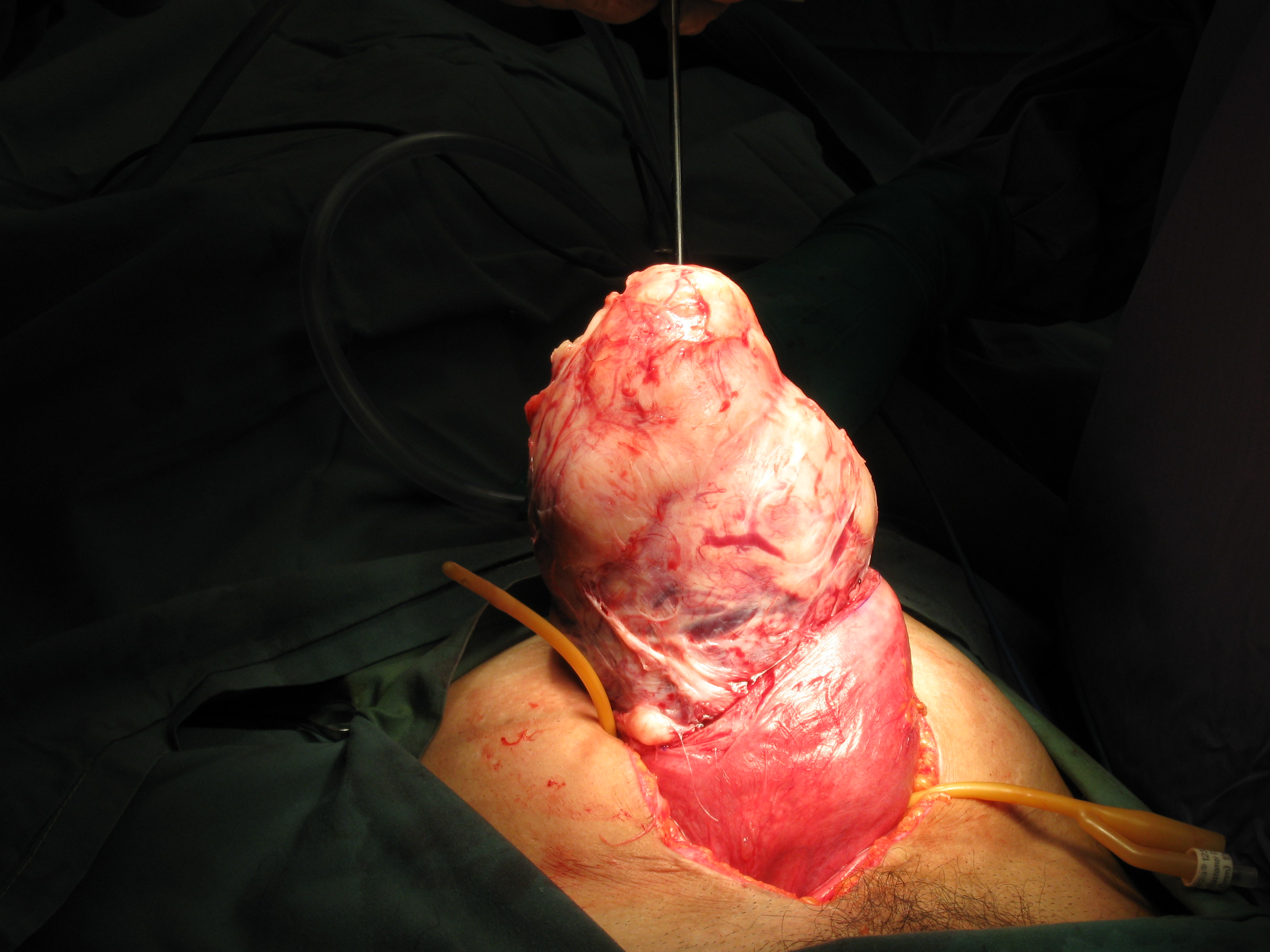 Fibroid Abdominal Myomectomy Serag Youssif (9)